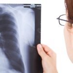 Santa Fe, entre las provincias con mayor aumento de casos de tuberculosis